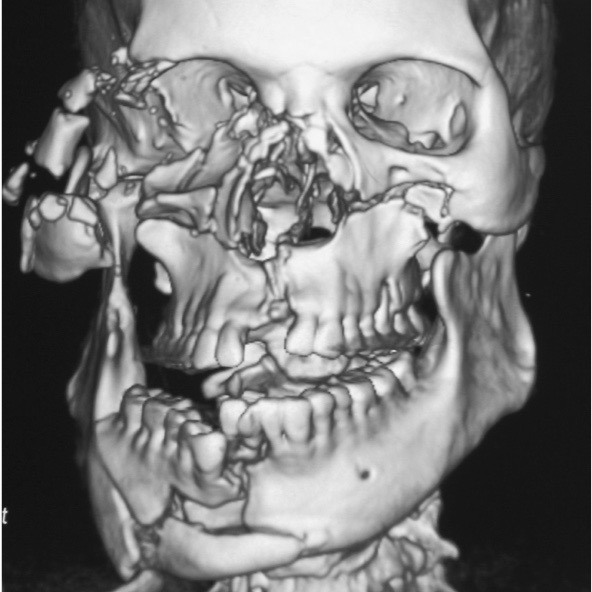 Reconstructive Facial Surgery