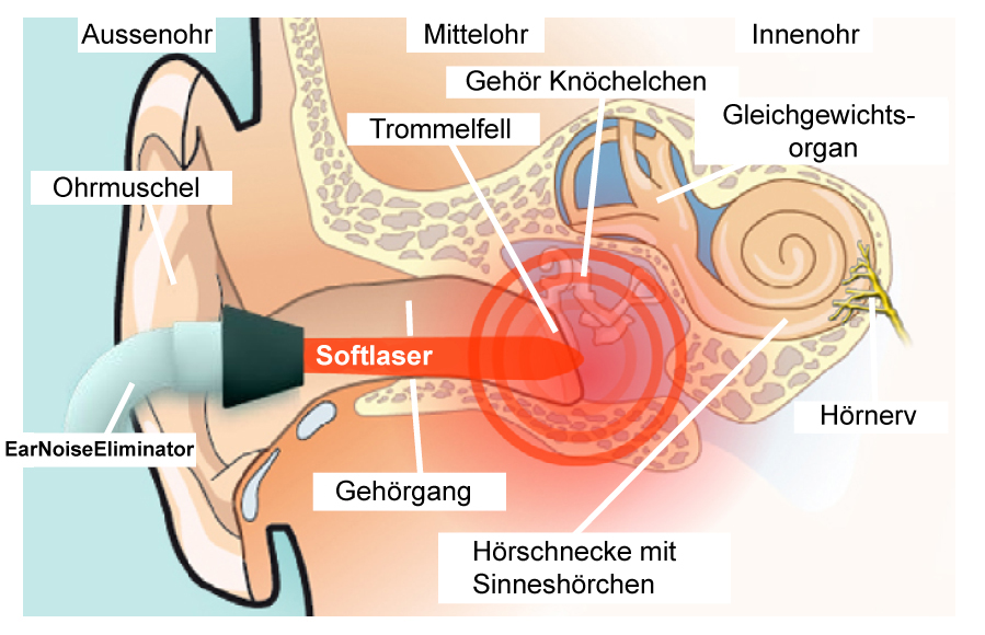 Foto-Beschreibung-Wirkungsweise-EarNoiseEliminator-gegen-Tinnitus