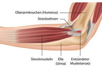 tennis-ellenbogen_1jpg