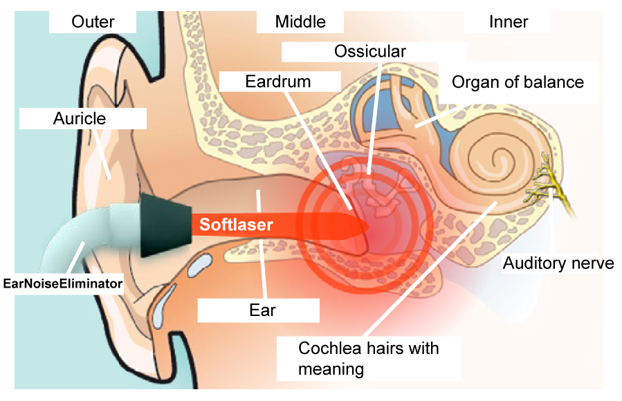 Photo-description-mode of action-EarNoiseEliminator-against-tinnitus