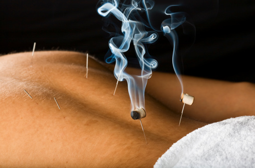 Moxa oder Moxibustion ist eine Therapiemethode der Traditionellen Chinesischen Medizin (TCM), bei der Akupunkturpunkte durch glimmendes Beifusskraut erwärmt werden.